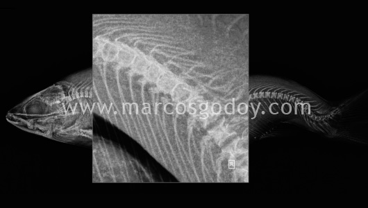 scoliosis-v1