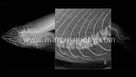 scoliosis-viii