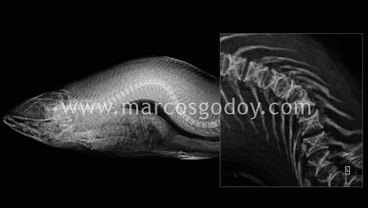 scoliosis-x