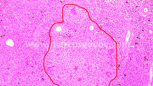 granulomatous-nephritis-i