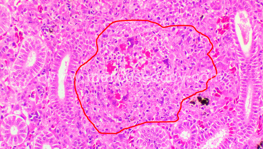 granulomatous-nephritis-ii