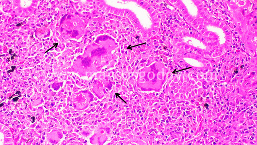 granulomatous-nephritis-iii