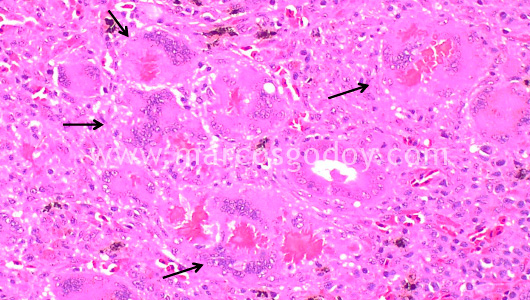 granulomatous-nephritis-iv