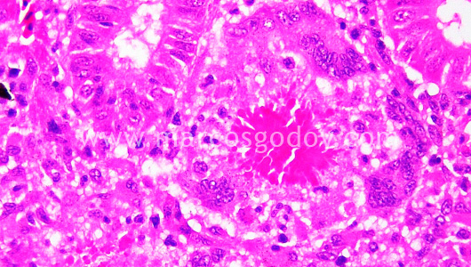 granulomatous-nephritis-vi