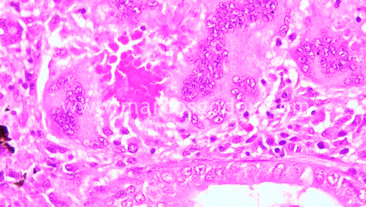 granulomatous-nephritis-vii