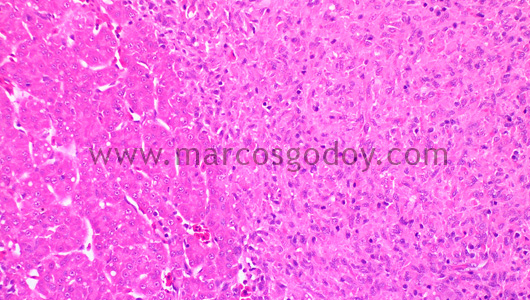 granulomatous-hepatitis-i