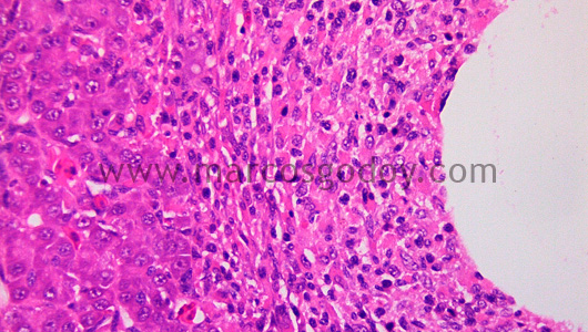 granulomatous-hepatitis-ii