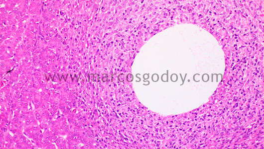 granulomatous-hepatitis-iii
