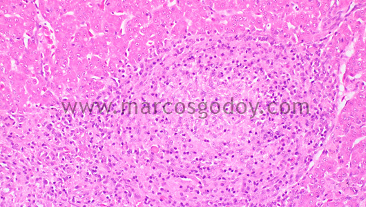 granulomatous-hepatitis-iv1