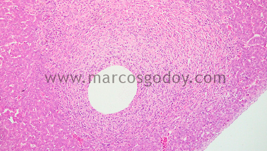 granulomatous-hepatitis-ix