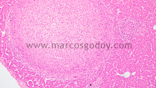 granulomatous-hepatitis-viii1