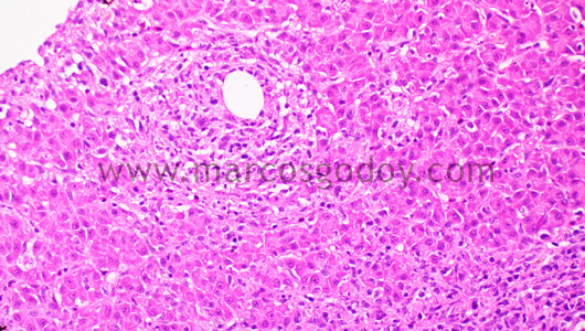 granulomatous-hepatitis-x