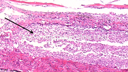 dermatitis-i dermatitis-i