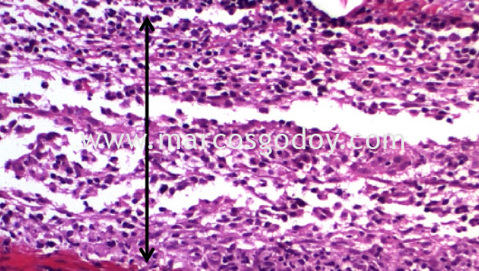dermatitis-iii dermatitis-iii