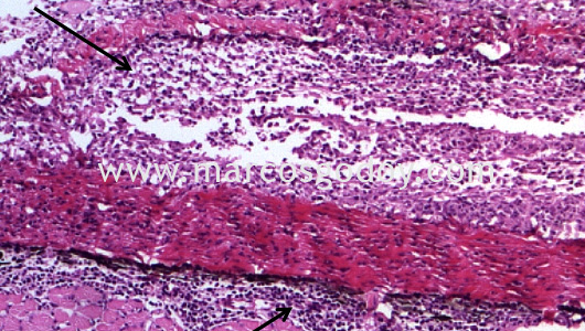 dermatitis-iv dermatitis-iv
