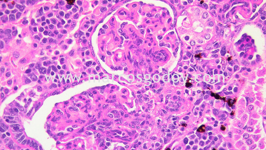 membranous-glomerulonephritis-i