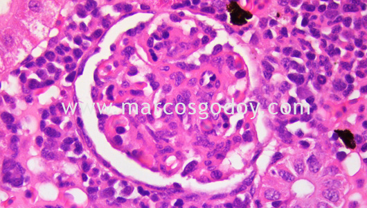 membranous-glomerulonephritis-iii