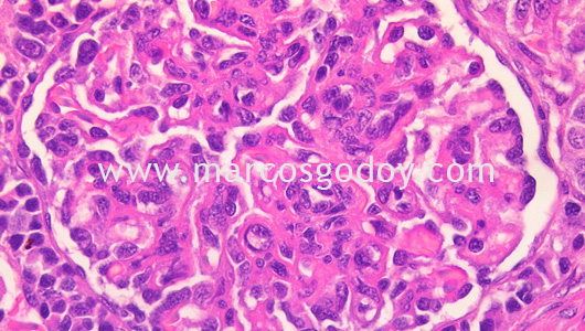 membranous-glomerulonephritis-iv