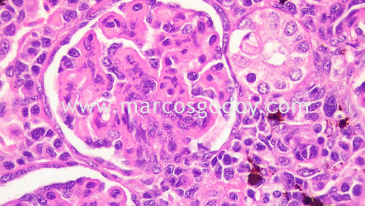 membranous-glomerulonephritis-v