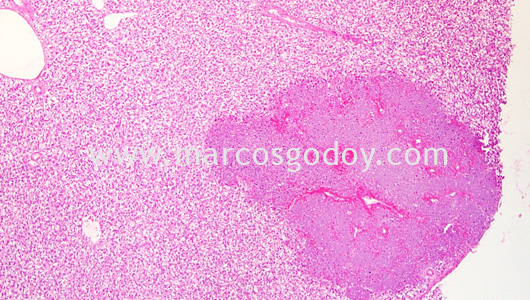 bkd-liver-pathology-i