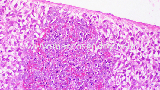 bkd-liver-pathology-ii