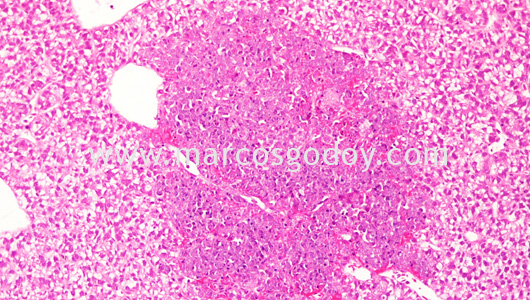 bkd-liver-pathology-iii