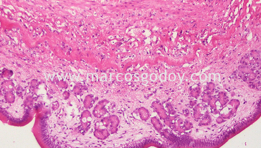 gastric-dilatation-histopatology-iii gastric-dilatation-histopatology-iii