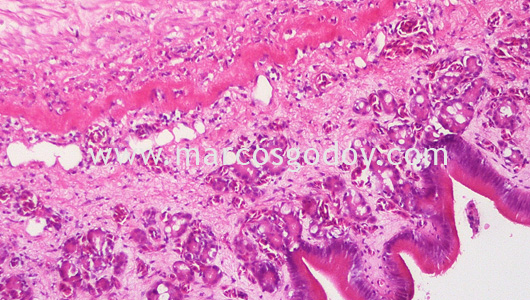 gastric-dilatation-histopatology-iv gastric-dilatation-histopatology-iv