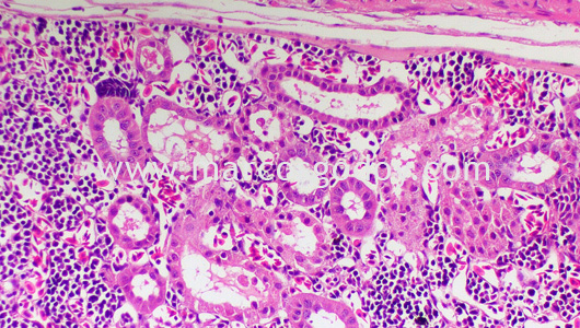 acute-necrosis-tubular-ii