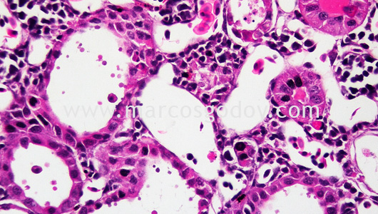 acute-necrosis-tubular-iii