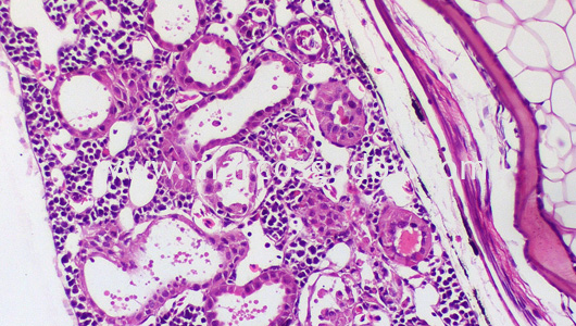 acute-necrosis-tubular-iv