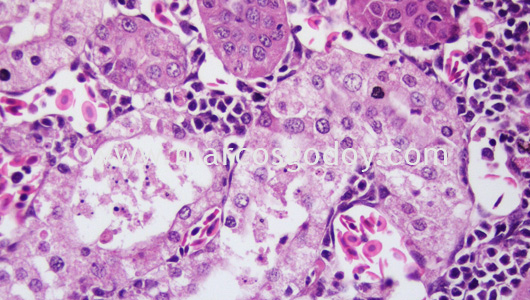 acute-necrosis-tubular-v