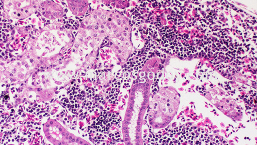 acute-necrosis-tubular-vi