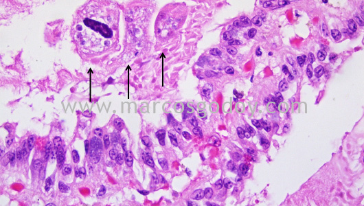 mantoscyphidia-concholepas-v