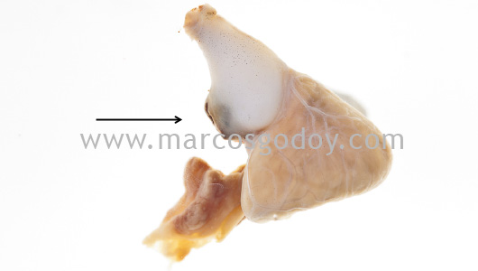 pseudoaneurisma-bulbo-arterioso-i pseudoaneurisma-bulbo-arterioso-i