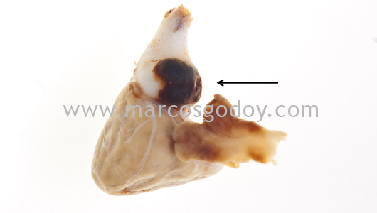 pseudoaneurisma-bulbo-arterioso-ii pseudoaneurisma-bulbo-arterioso-ii