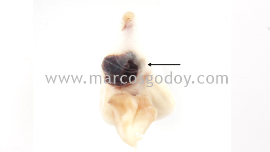 pseudoaneurisma-bulbo-arterioso-iii pseudoaneurisma-bulbo-arterioso-iii