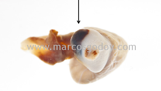 pseudoaneurisma-bulbo-arterioso-iv pseudoaneurisma-bulbo-arterioso-iv