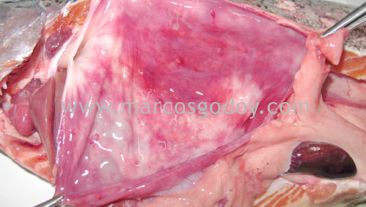 gastritis-i