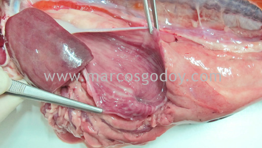 gastritis-ii1
