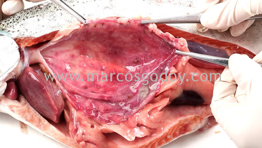 gastritis-iii