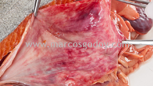 gastritis-iv