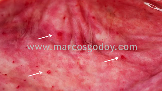 gastritis-v