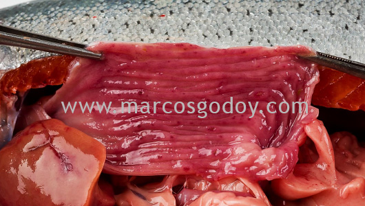 gastritis-vi