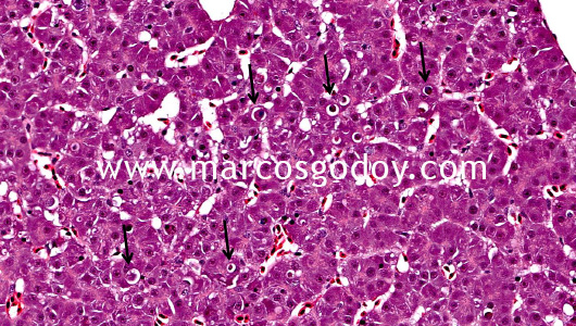 hepatic-necrosis-i