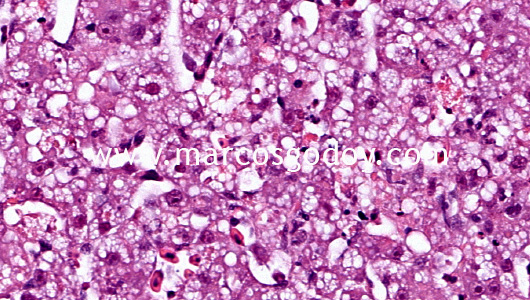 hepatic-necrosis-iii