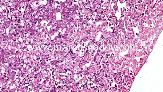 hepatic-necrosis-ix1