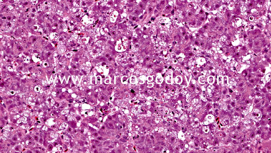 hepatic-necrosis-vi