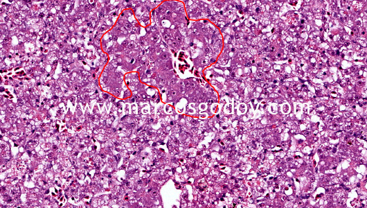 hepatic-necrosis-vii1
