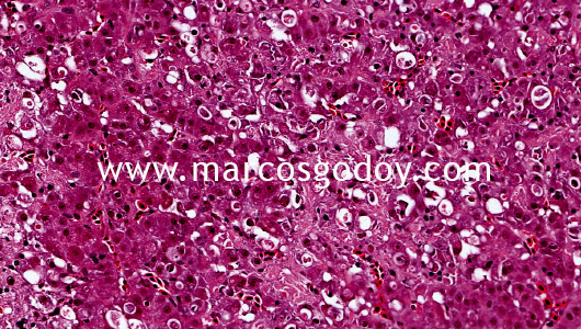 hepatic-necrosis-viii